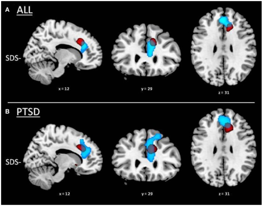 Neurobiologie des troubles du sommeil chez les patients souffrant d'ESPT et les témoins traumatisés : Résultats de l'IRM et de la SPECT.